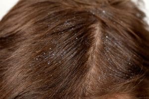 علاج الشعر من القشرة