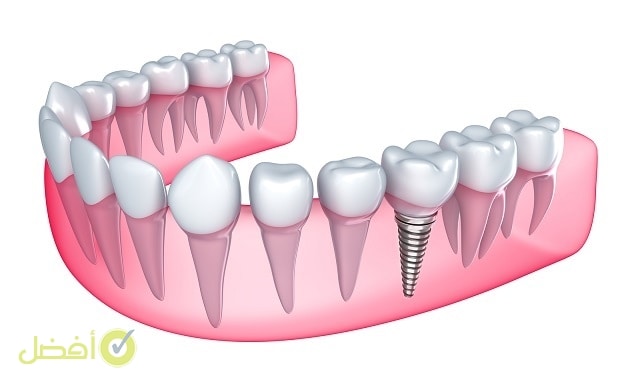 زراعة الاسنان في خمس دقائق أفضل طبيب لزرع الأسنان في الرياض